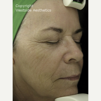 Fraxel for Deep Wrinkles and Sun Spots after 3065417