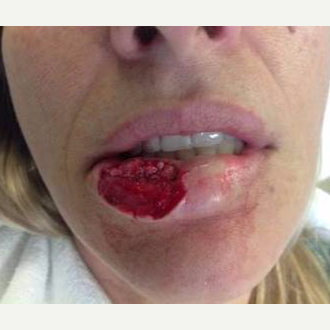 35-44 year old woman treated with Lip Augmentation before 3669778
