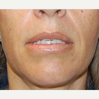 35-44 year old woman treated with Lip Augmentation after 3669778