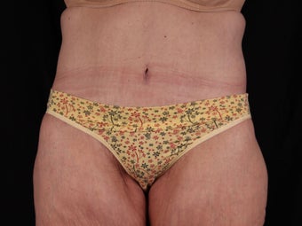 Body Lift (Beltlipectomy) after 1494083