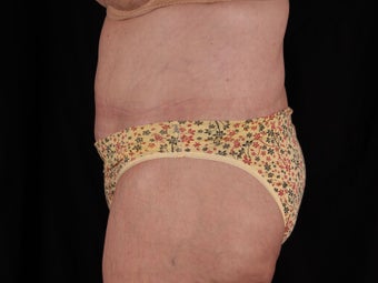 Body Lift (Beltlipectomy) 1494083