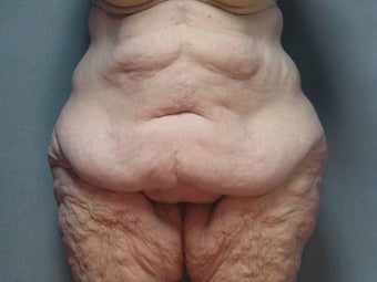 Body Lift (Beltlipectomy) before 1494083