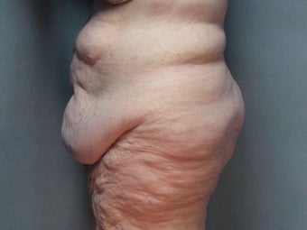 Body Lift (Beltlipectomy) 1494083
