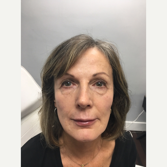 45-54 year old woman treated with Non Surgical Face Lift after 3684513