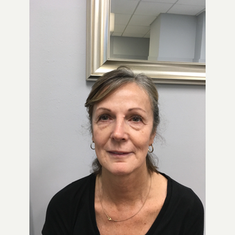 45-54 year old woman treated with Non Surgical Face Lift before 3684513