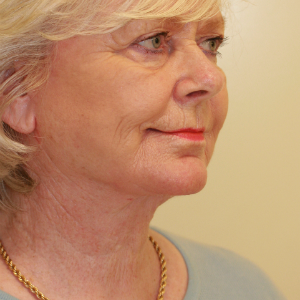 65-74 year old woman treated with Neck Lift after 3555289