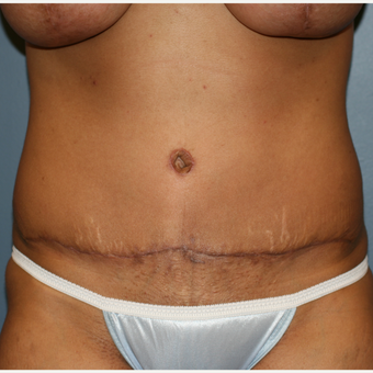 32 year old female Liposuction Tummy Tuck after 3638853