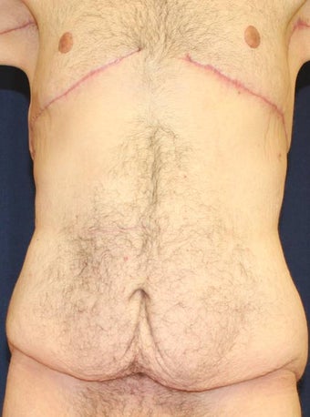 Male Body Lift before 879367
