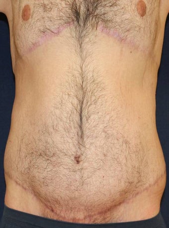 Male Body Lift after 879367