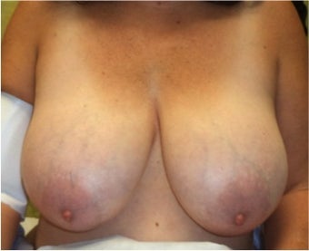 50 Year Old Female Treated For Macromastia with Breast Reduction before 1479011
