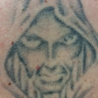 25-34 year old man treated with Tattoo Removal on back before 2947319