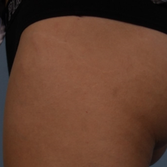 18-24 year old woman treated with Lux 1540 after 3225003