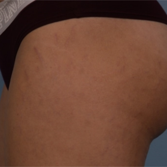 18-24 year old woman treated with Lux 1540 before 3225003