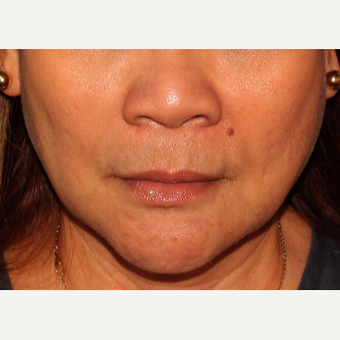 18-24 year old woman treated with Belotero before 3110606