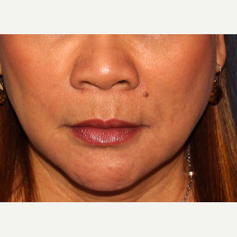 18-24 year old woman treated with Belotero after 3110606