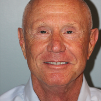 67 year old had a Lower Face Lift to improve the signs of aging after 3465106