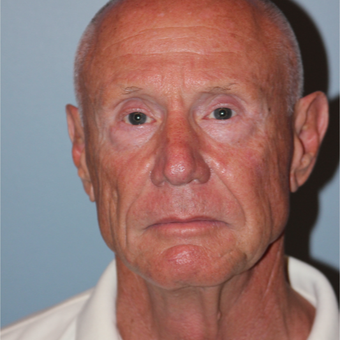 67 year old had a Lower Face Lift to improve the signs of aging before 3465106