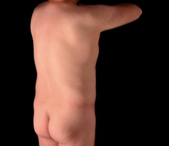 45-54 year old man treated with Fat Transfer before 3665340