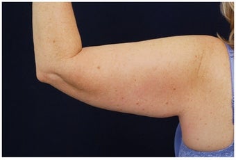 Brachioplasty before 1032007