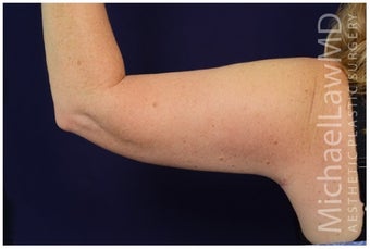 Brachioplasty after 1032007