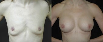 46 year old woman treated with Breast Augmentation before 2990404