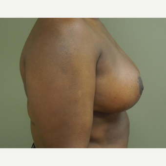 35-44 year old woman treated with Breast Reduction after 3530602