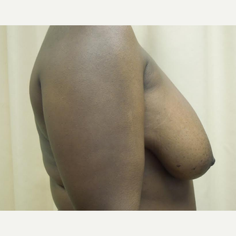35-44 year old woman treated with Breast Reduction before 3530602