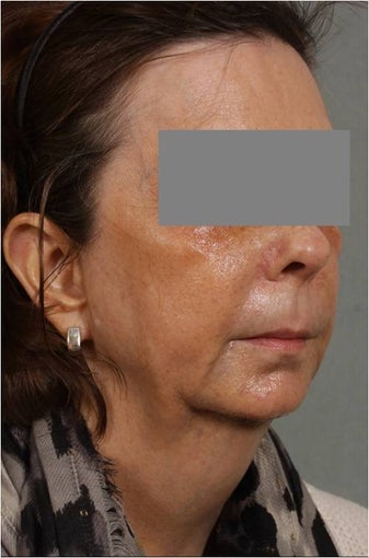 53 Year Old female with loss of cheek volume, hollowness under her eyes, nasolabial folds, and sagging jowls and neck. J 1150680