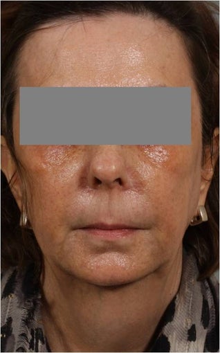 53 Year Old female with loss of cheek volume, hollowness under her eyes, nasolabial folds, and sagging jowls and neck. J before 1150680