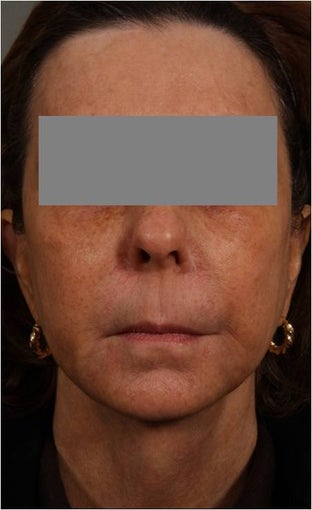 53 Year Old female with loss of cheek volume, hollowness under her eyes, nasolabial folds, and sagging jowls and neck. J after 1150680