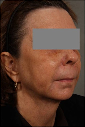 53 Year Old female with loss of cheek volume, hollowness under her eyes, nasolabial folds, and sagging jowls and neck. J 1150680