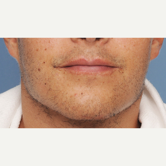 25-34 year old man treated with Chin Implant after 3316782