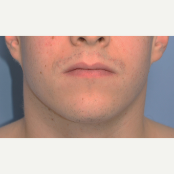 25-34 year old man treated with Chin Implant before 3316782