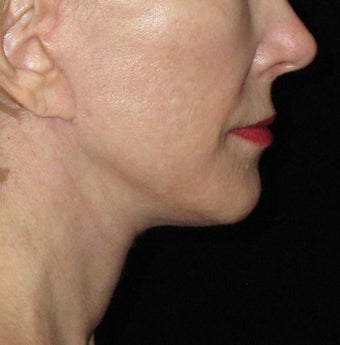 61 year old woman treated with Facelift and Necklift 2833879