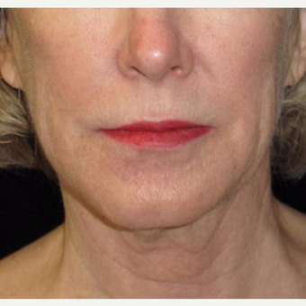 61 year old woman treated with Facelift and Necklift before 2833879