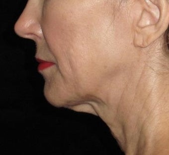 61 year old woman treated with Facelift and Necklift 2833879