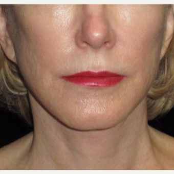 61 year old woman treated with Facelift and Necklift after 2833879