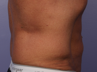 CoolSculpting by Zeltiq to Love Handles/Flanks after 375519