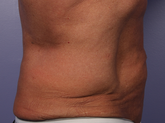 CoolSculpting by Zeltiq to Love Handles/Flanks before 375519