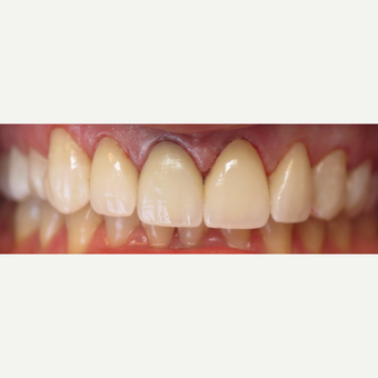25-34 year old man treated with Elite Crowns after 3202916