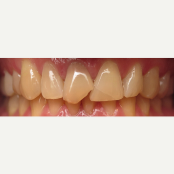 25-34 year old man treated with Elite Crowns before 3202916