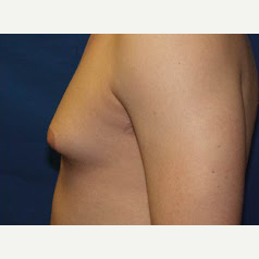 18-24 year old man treated with Male Breast Reduction before 3374866