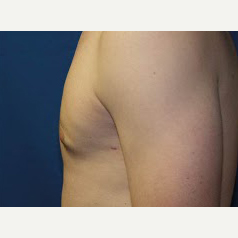 18-24 year old man treated with Male Breast Reduction after 3374866