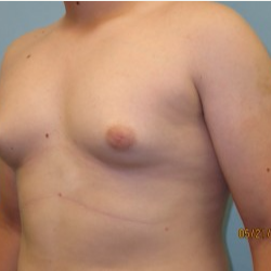 17 or under year old man treated with Male Breast Reduction before 3722291