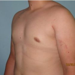 17 or under year old man treated with Male Breast Reduction after 3722291