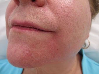 66 year old female treated with Radiesse for Marionette Lines after 995546