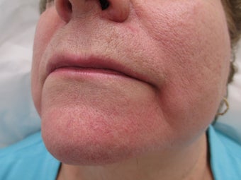 66 year old female treated with Radiesse for Marionette Lines before 995546