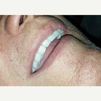 65-74 year old man treated with Smile Makeover after 3630950