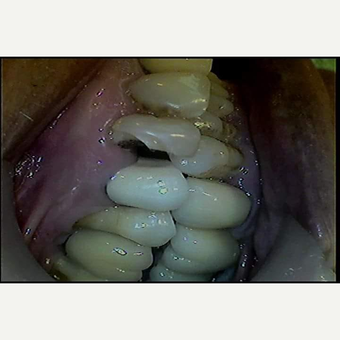 65-74 year old man treated with Smile Makeover before 3630950