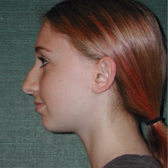 17 or under year old woman treated with Rhinoplasty before 3205311